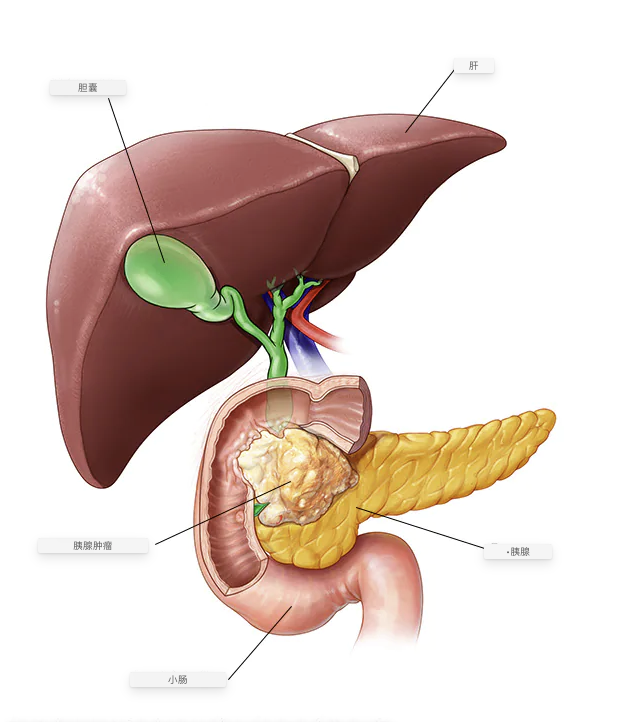 胰腺癌pancreatic cancer